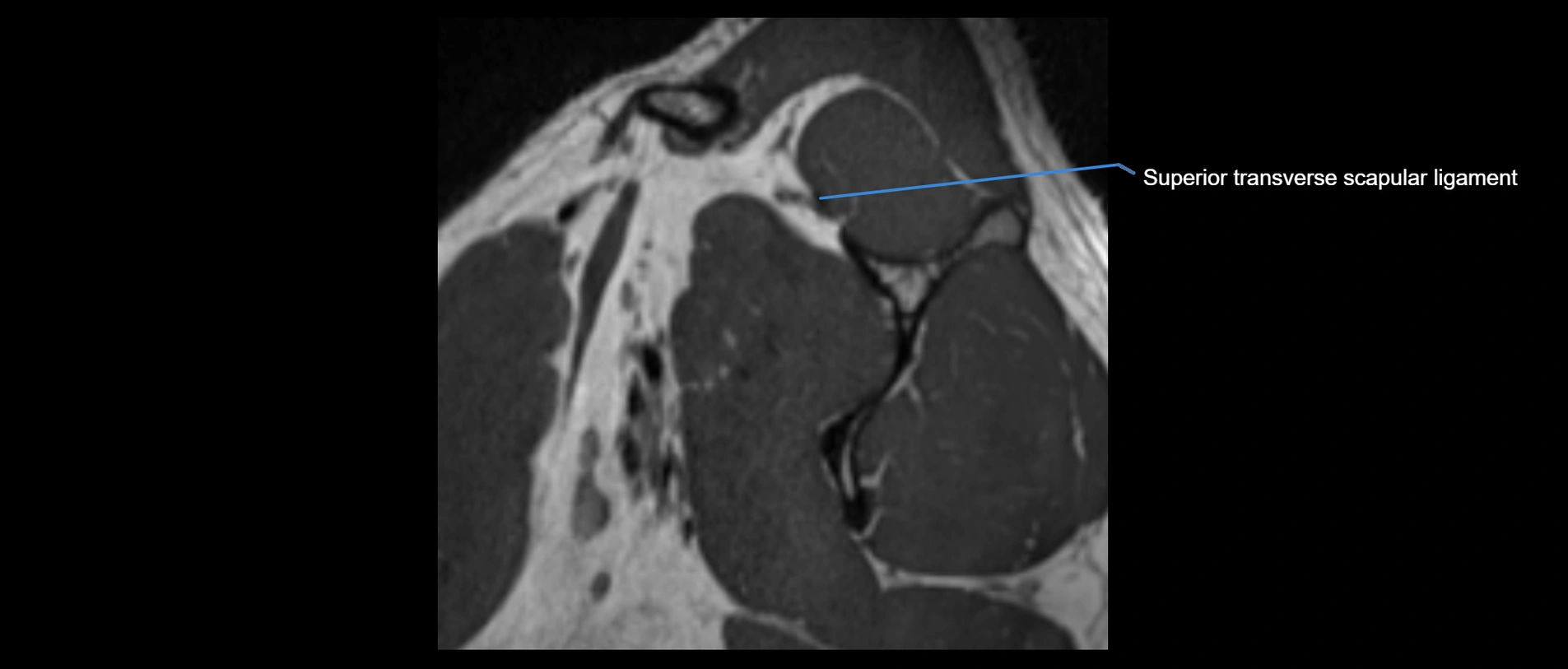 shoulder ligaments sagittal  cross sectional anatomy 3T MRI AI enhanced radiology image -img-00001-00008.webp